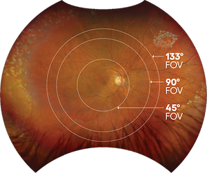 Optos Retina Image